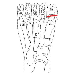 左足拇趾近节骨折被鉴定为十级工伤