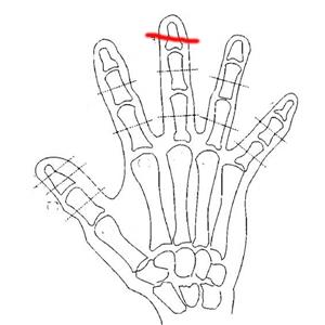右手中指切割伤、右中指末端开放性骨折被鉴定为十级工伤